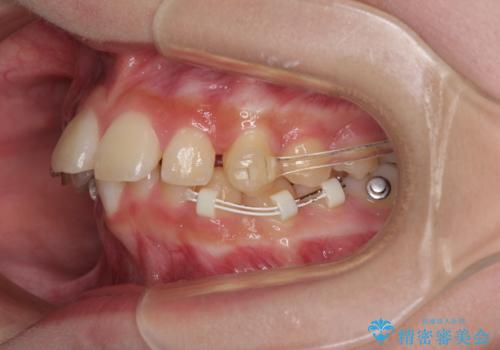 下の前歯が隠れてしまうほど深い咬み合わせ 高校生のインビザライン矯正治療の治療中