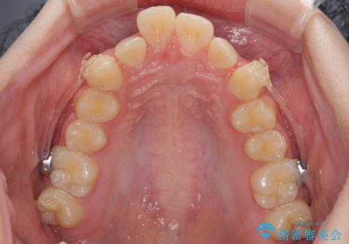 下の前歯が隠れてしまうほど深い咬み合わせ 高校生のインビザライン矯正治療の治療中