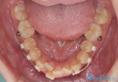 下の前歯が隠れてしまうほど深い咬み合わせ 高校生のインビザライン矯正治療の治療中