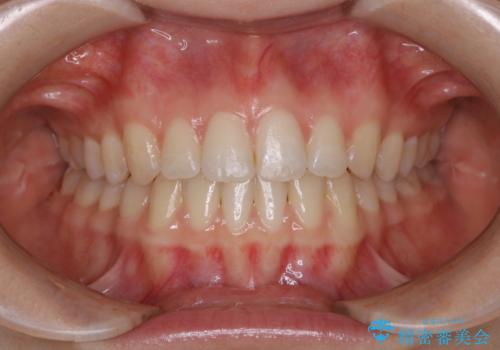 見た目だけじゃない:マウスピースでも短期間で噛み合わせと口元を改善の治療後