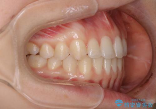 見た目だけじゃない:マウスピースでも短期間で噛み合わせと口元を改善の治療後