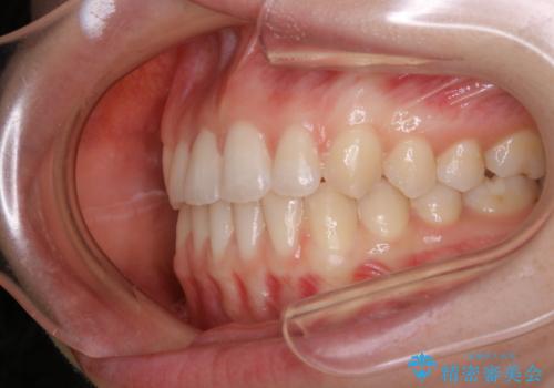 見た目だけじゃない:マウスピースでも短期間で噛み合わせと口元を改善の治療後