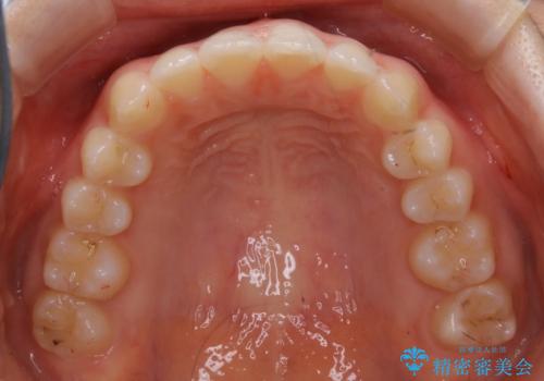 見た目だけじゃない:マウスピースでも短期間で噛み合わせと口元を改善の治療後