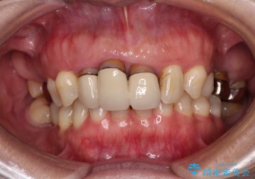 歯茎の縁に見える変色を隠したい　前歯のオールセラミッククラウンの治療前