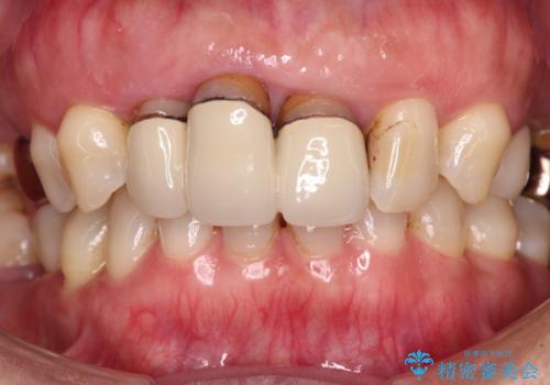 歯茎の縁に見える変色を隠したい 前歯のオールセラミッククラウンの治療前