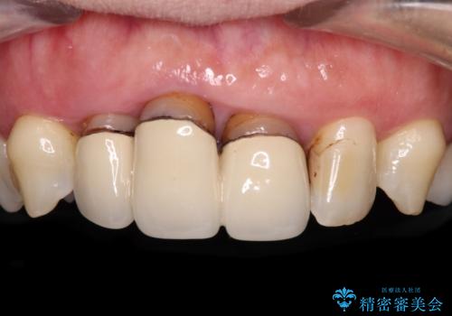歯茎の縁に見える変色を隠したい　前歯のオールセラミッククラウンの症例 治療前