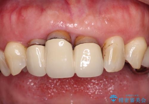 歯茎の縁に見える変色を隠したい 前歯のオールセラミッククラウンの治療前