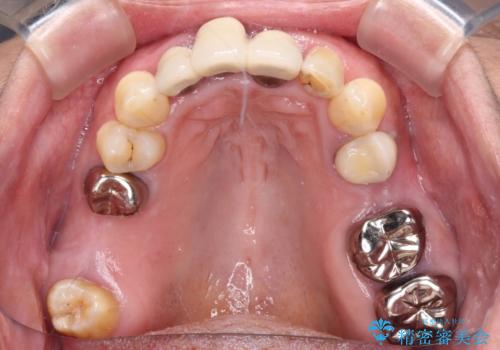 歯茎の縁に見える変色を隠したい 前歯のオールセラミッククラウンの治療前