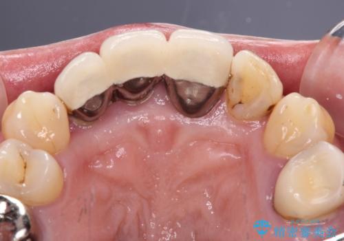 歯茎の縁に見える変色を隠したい 前歯のオールセラミッククラウンの治療前