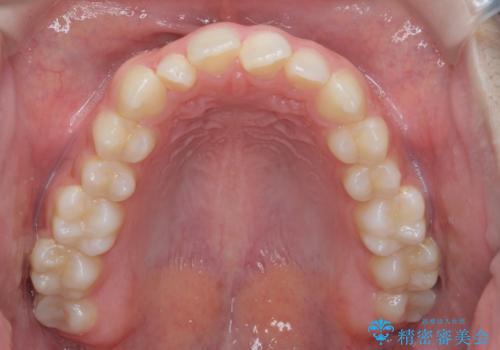 前歯のガタつき・ねじれを治すマウスピース矯正の治療前