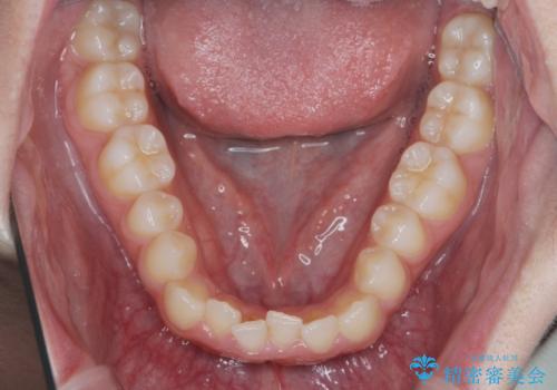 前歯のガタつき・ねじれを治すマウスピース矯正の治療前