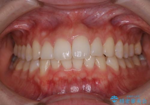 オフィスホワイトニング【スペシャルコース】の治療前