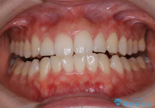 オフィスホワイトニング【スペシャルコース】の治療前