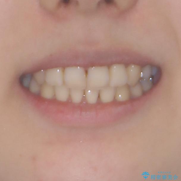 前歯の歯並びを治したい　ワイヤー装置での抜歯矯正の治療後（顔貌）