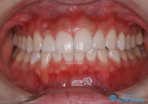 オフィスホワイトニング【スペシャルコース】の治療後