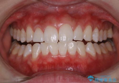 オフィスホワイトニング【スペシャルコース】の治療後