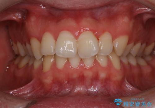 人生初めて歯のクリーニング(PMTC)の治療前
