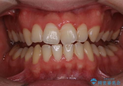 人生初めて歯のクリーニング(PMTC)の治療前