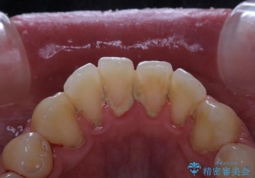 人生初めて歯のクリーニング(PMTC)の症例 治療前