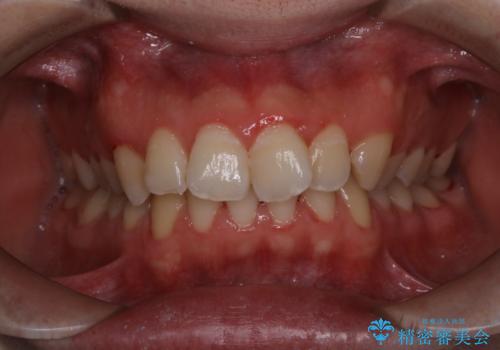 人生初めて歯のクリーニング(PMTC)の治療後