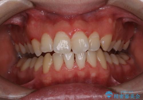 人生初めて歯のクリーニング(PMTC)の治療後
