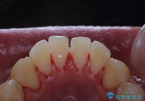 人生初めて歯のクリーニング(PMTC)の症例 治療後
