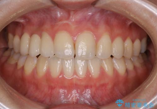 歯がないところに歯をつくる:矯正とセラミックの合わせ技で審美的な口元をの治療後