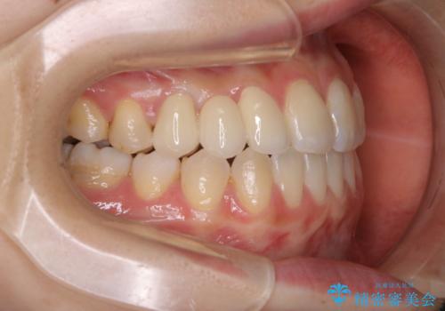歯がないところに歯をつくる:矯正とセラミックの合わせ技で審美的な口元をの治療後