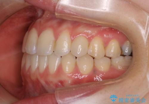 歯がないところに歯をつくる:矯正とセラミックの合わせ技で審美的な口元をの治療後