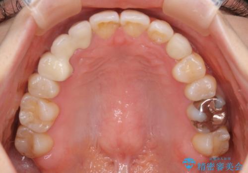 歯がないところに歯をつくる:矯正とセラミックの合わせ技で審美的な口元をの治療後