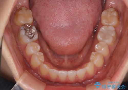 歯がないところに歯をつくる:矯正とセラミックの合わせ技で審美的な口元をの治療後