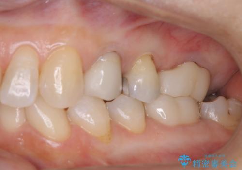 大好きなブラックコーヒーによる歯の着色を綺麗にしたいの治療後