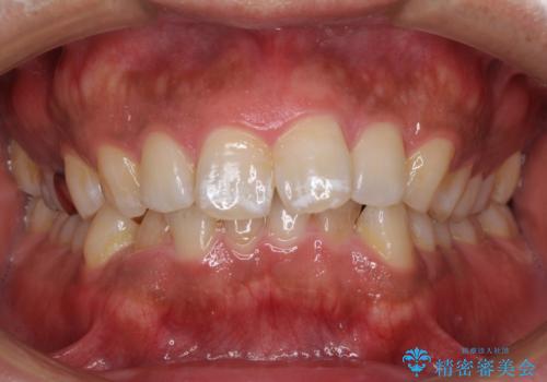 インビザラインによる矯正治療と、折れてしまった歯のインプラント補綴治療の治療前