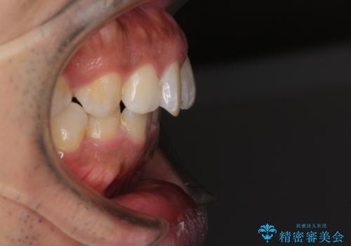 インビザラインによる矯正治療と、折れてしまった歯のインプラント補綴治療の治療前