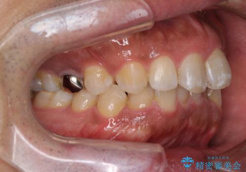 インビザラインによる矯正治療と、折れてしまった歯のインプラント補綴治療の治療前