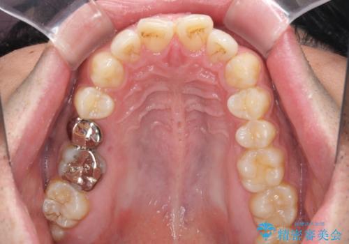 インビザラインによる矯正治療と、折れてしまった歯のインプラント補綴治療の治療前