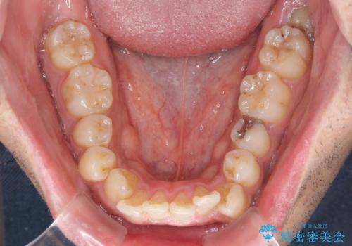 インビザラインによる矯正治療と、折れてしまった歯のインプラント補綴治療の治療前