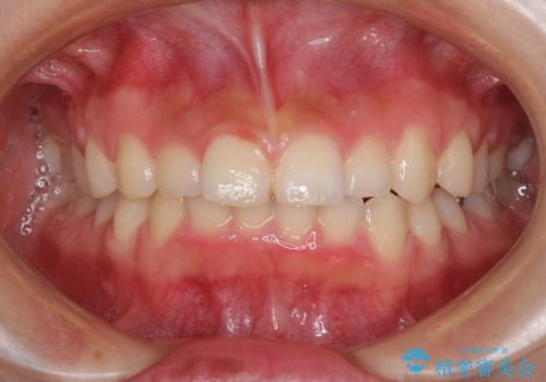 前歯のデコボコと突出感　インビザラインによる矯正治療の治療前