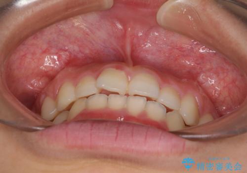 前歯のデコボコと突出感 インビザラインによる矯正治療の治療前