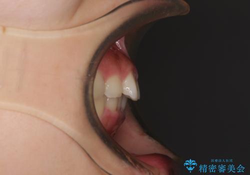 前歯のデコボコと突出感 インビザラインによる矯正治療の治療前