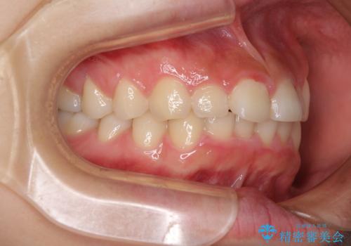 前歯のデコボコと突出感 インビザラインによる矯正治療の治療前