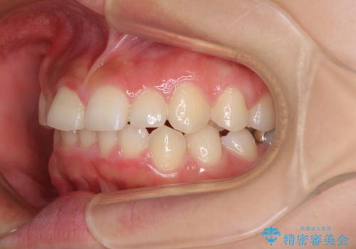 前歯のデコボコと突出感 インビザラインによる矯正治療の治療前