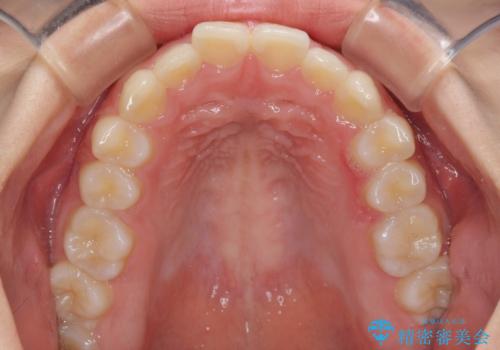 前歯のデコボコと突出感 インビザラインによる矯正治療の治療前
