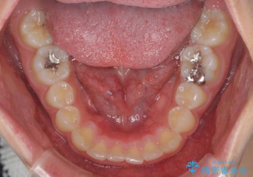 前歯のデコボコと突出感　インビザラインによる矯正治療の治療前
