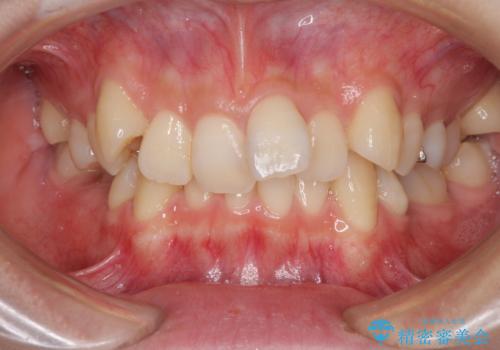 前歯の歯並びを治したい ワイヤー装置での抜歯矯正の症例 治療前