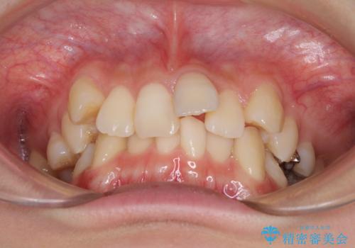 前歯の歯並びを治したい　ワイヤー装置での抜歯矯正の治療前