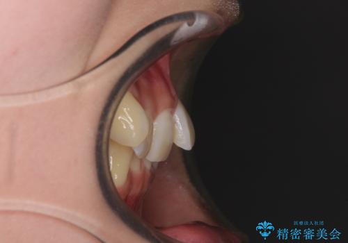 前歯の歯並びを治したい ワイヤー装置での抜歯矯正の治療前