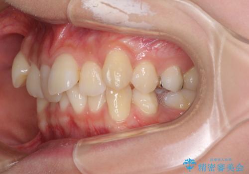 前歯の歯並びを治したい ワイヤー装置での抜歯矯正の治療前