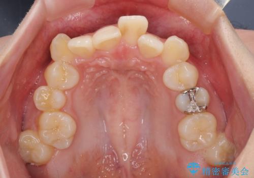 前歯の歯並びを治したい ワイヤー装置での抜歯矯正の治療前