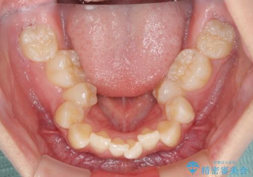 前歯の歯並びを治したい ワイヤー装置での抜歯矯正の治療前